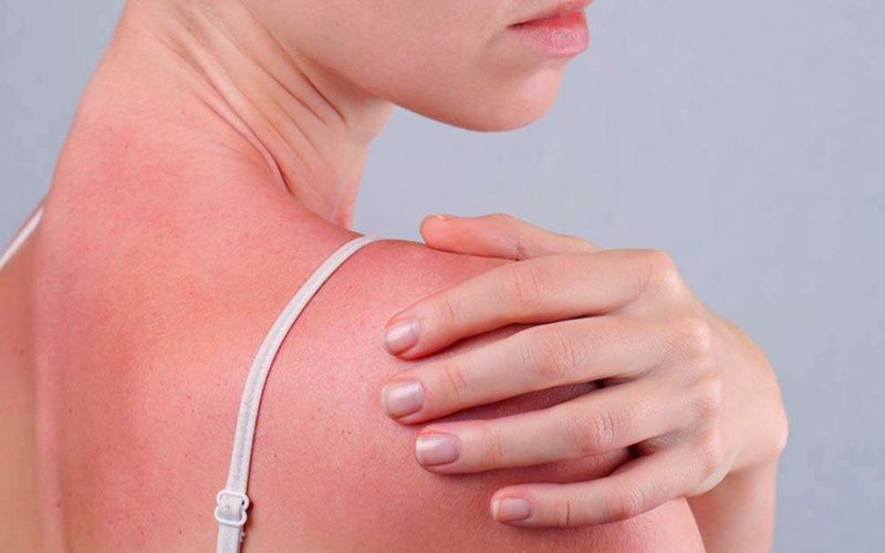 Prepoznavanje i Zaštitta Od Alergija Na Suncu
